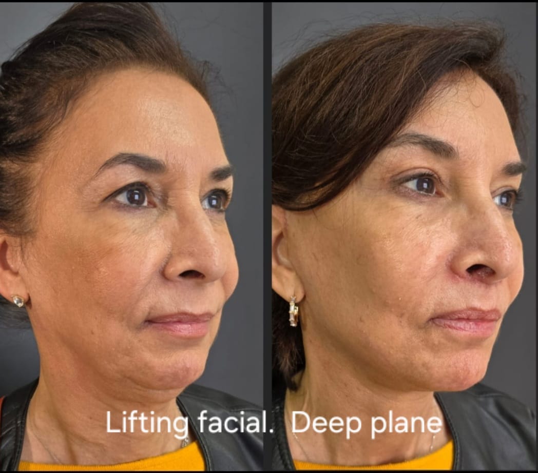 Lifting facial deep plane, foto 2 — antes y después