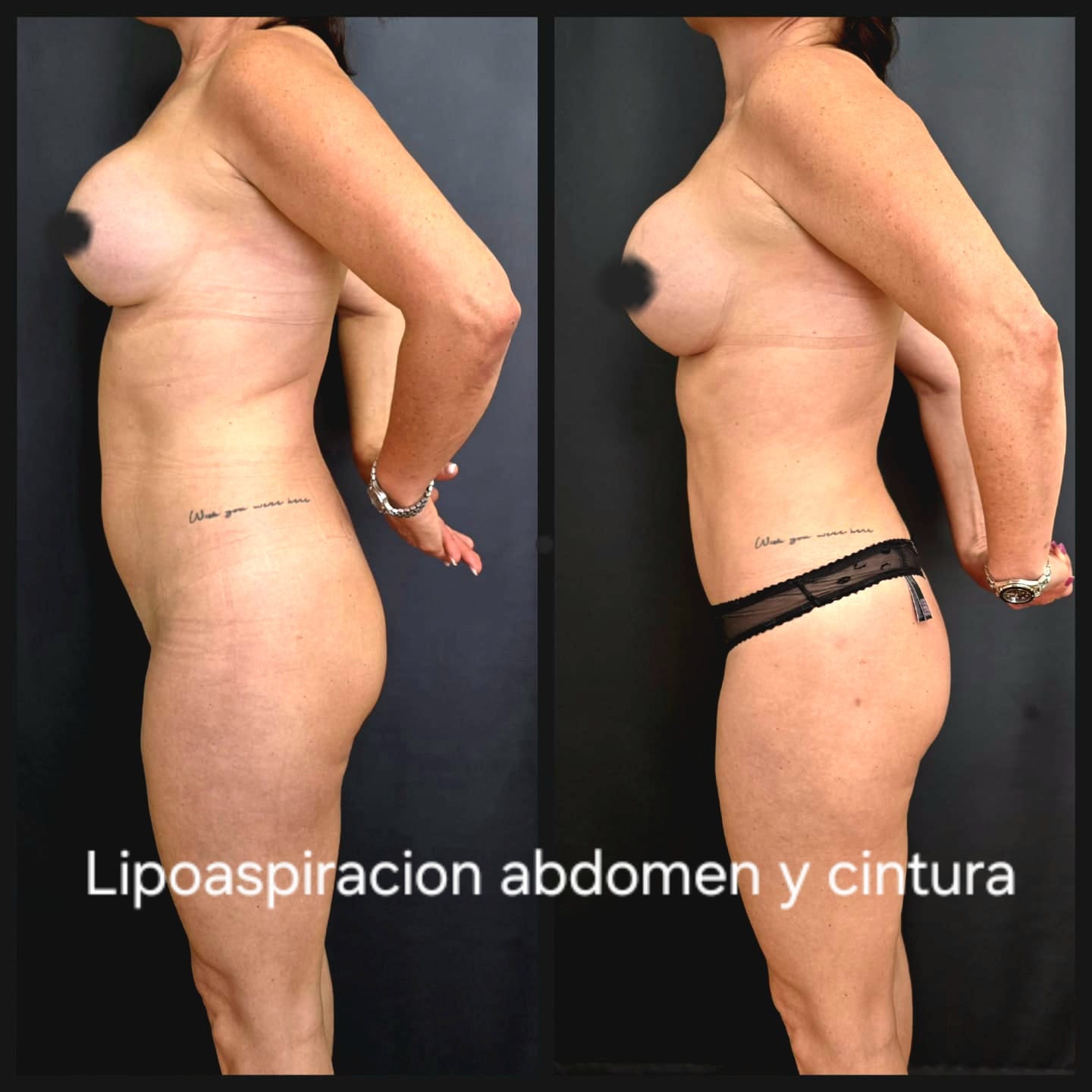Lipoaspiración de abdomen y cintura — antes y después