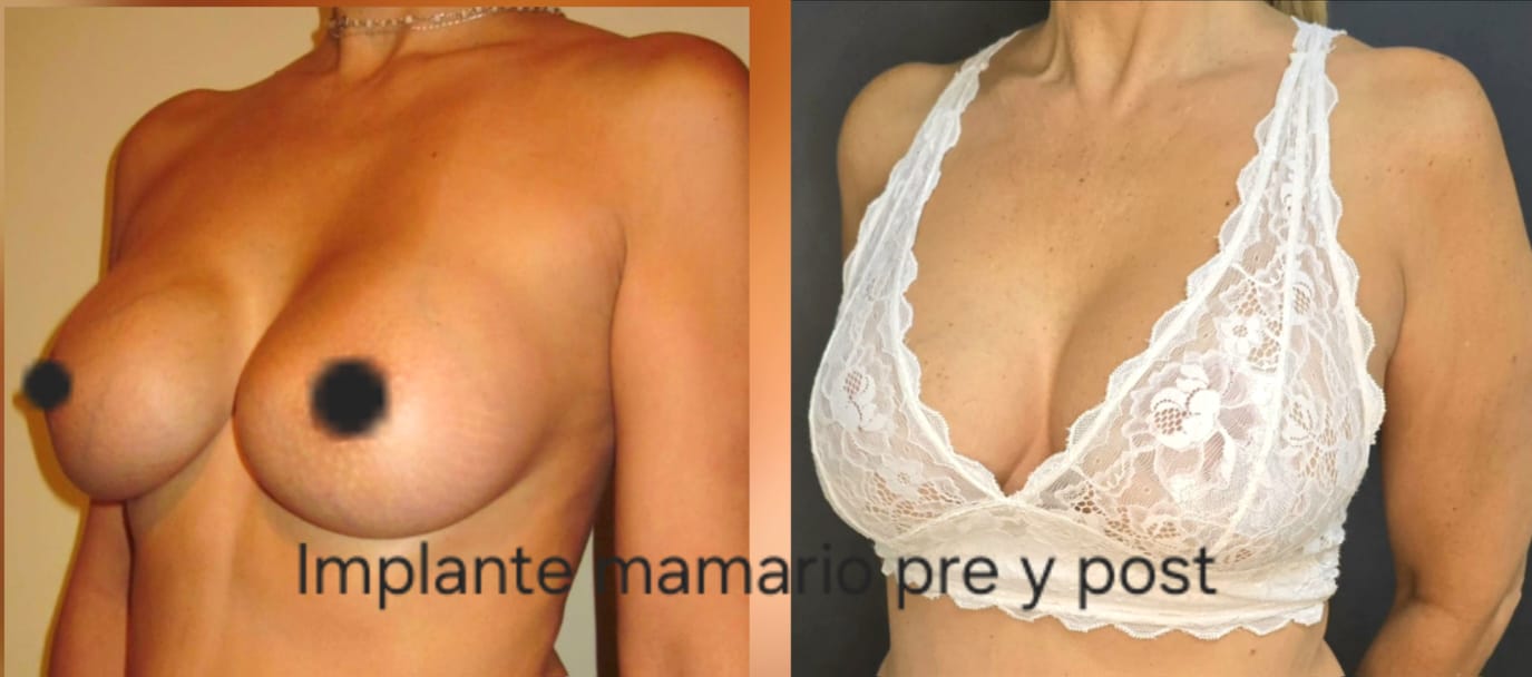 Implante mamario, foto 3 — antes y después